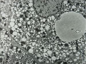 M,7y. | Wilson disease susp.